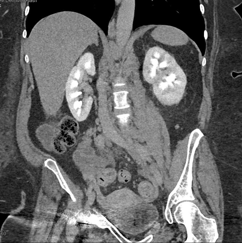 Extensive Adenopathy from Renal Cell Carcinoma - CTisus CT Scan