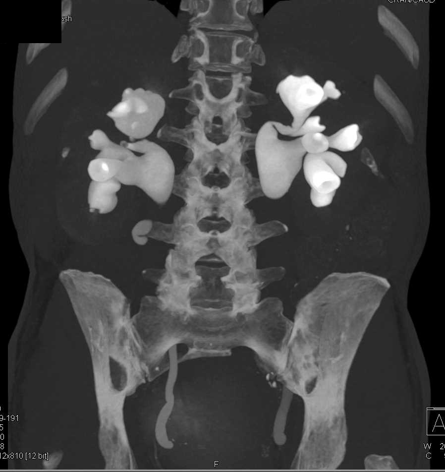Acute Pyelonephritis with Dilated Renal Pelvis and Calyces - CTisus CT Scan