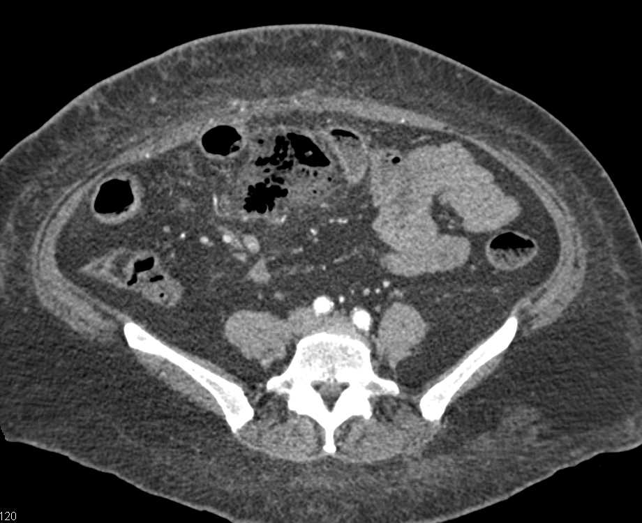 Renal Infarction in Patient with Vasculitis - CTisus CT Scan