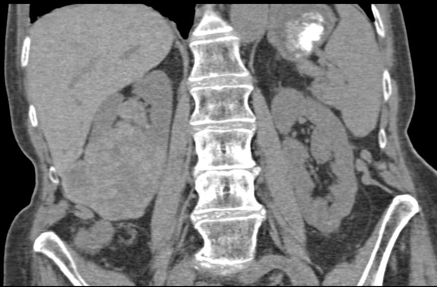 Renal Cell Carcinoma with Extensive Adenopathy - CTisus CT Scan