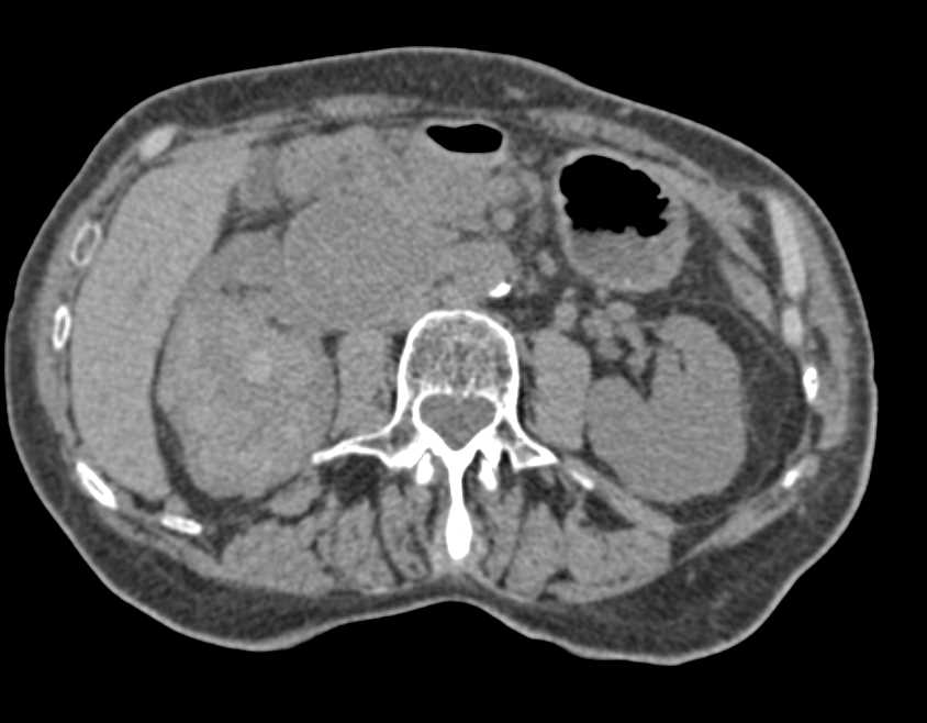 Renal Cell Carcinoma with Extensive Adenopathy - CTisus CT Scan