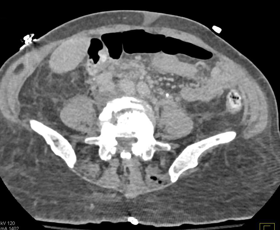 Multifocal Left Renal Masses due to Lymphoma - CTisus CT Scan