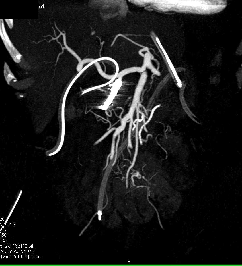 Metastases from the Kidney to Pancreas in Patient with a Left Nephrectomy - CTisus CT Scan