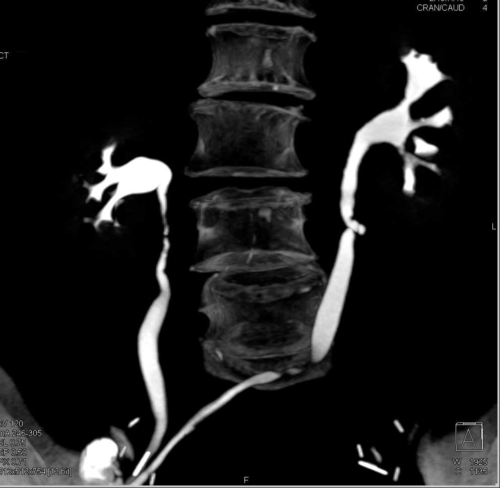 Transitional Carcinoma Left Kidney Near Ureter Reconstruction - CTisus CT Scan