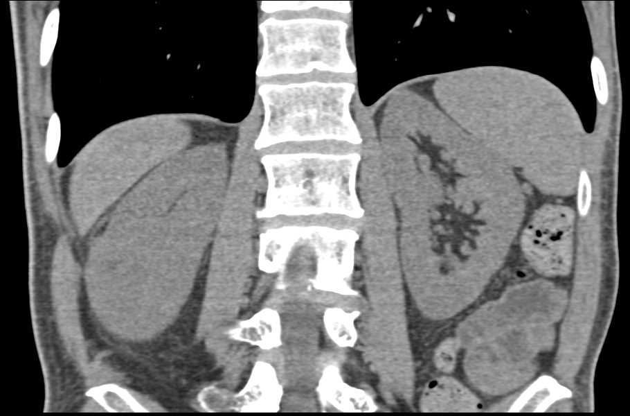 Small Right Incidental Renal Myelolipoma - CTisus CT Scan