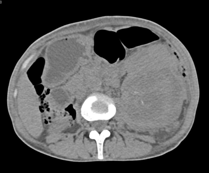 Renal Cell Carcinoma with Bulky Adenopathy - CTisus CT Scan