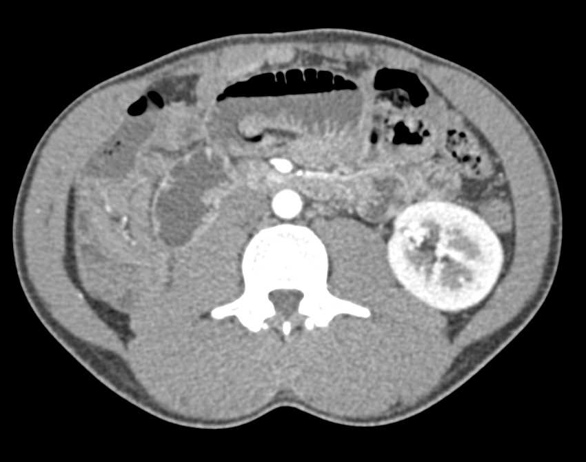 Small Bowel Obstruction (SBO) in Patient with Nephrectomy - CTisus CT Scan