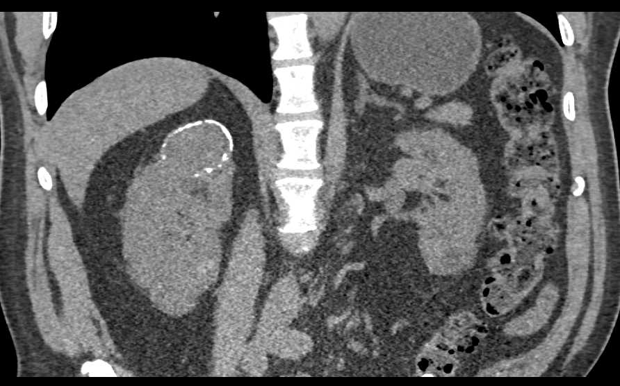 Papillary Renal Cell Carcinoma with Calcification - CTisus CT Scan