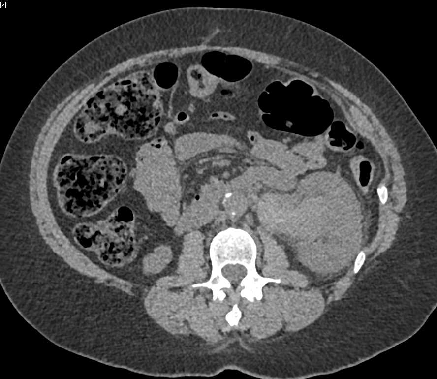 Transitional Cell Carcinoma Left Kidney - CTisus CT Scan