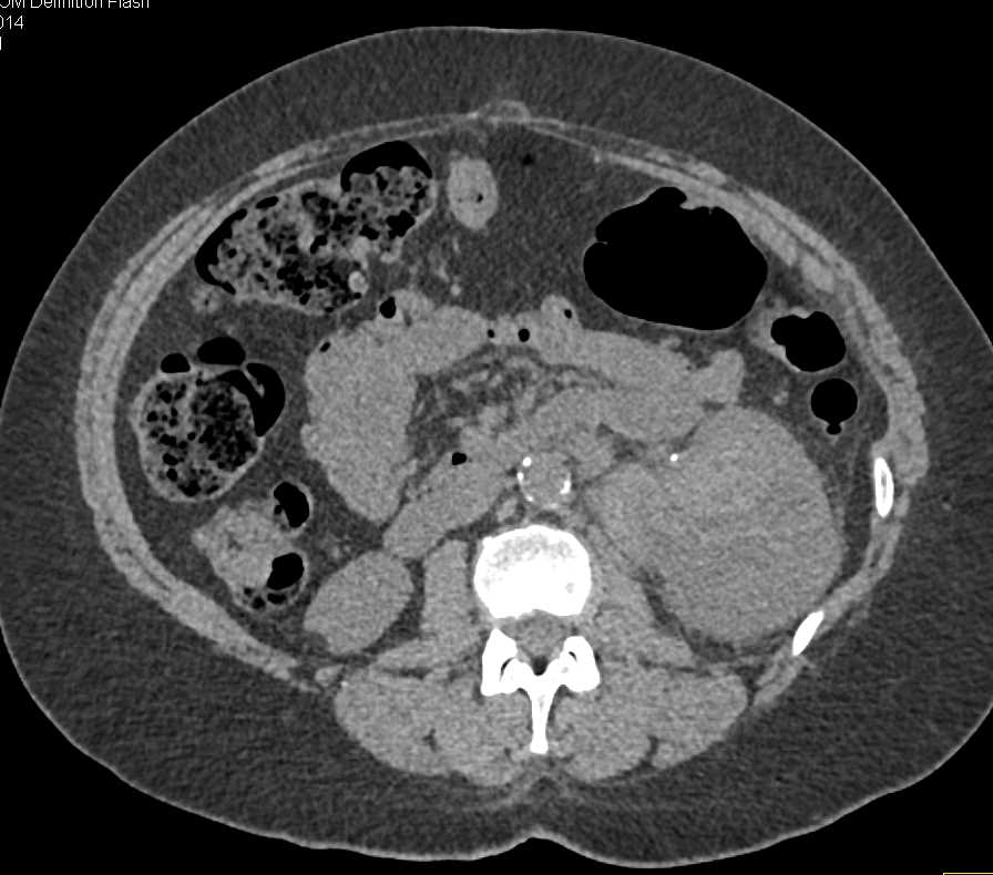 Transitional Cell Carcinoma Left Kidney - CTisus CT Scan