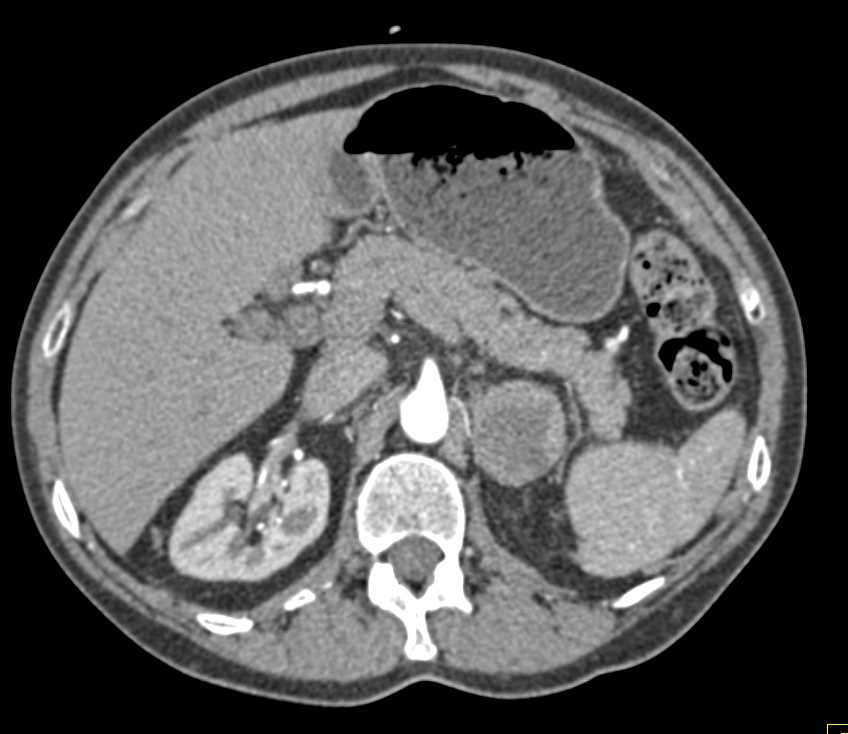 Renal Cell Carcinoma with Extensive Adenopathy - CTisus CT Scan