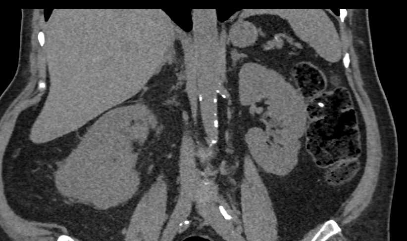 Papillary Renal Cell Carcinoma Invades the Renal Vein and the Inferior Vena Cava (IVC) - CTisus CT Scan