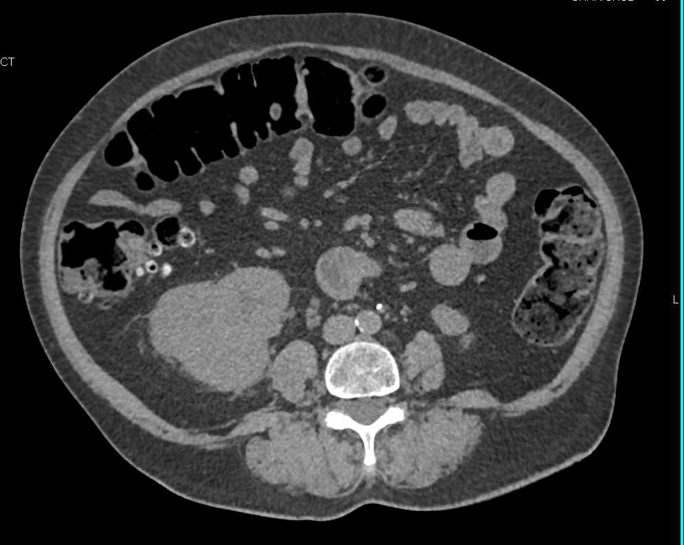 Papillary Renal Cell Carcinoma Invades the Renal Vein and the Inferior Vena Cava (IVC) - CTisus CT Scan