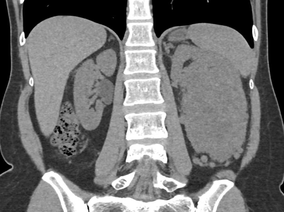 Renal Cell Carcinoma - CTisus CT Scan