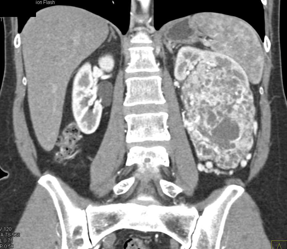 Renal Cell Carcinoma with Neovascularity - CTisus CT Scan