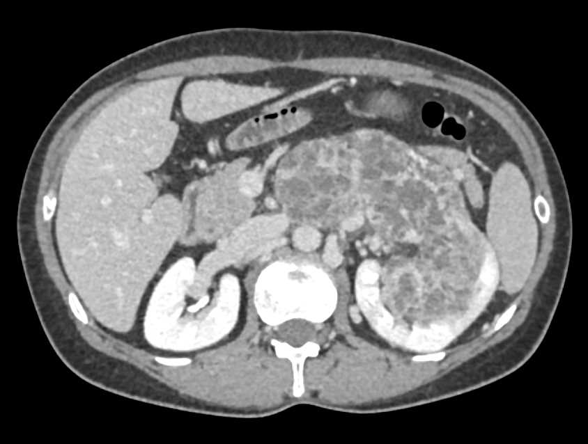 Renal Cell Carcinoma with Neovascularity - CTisus CT Scan