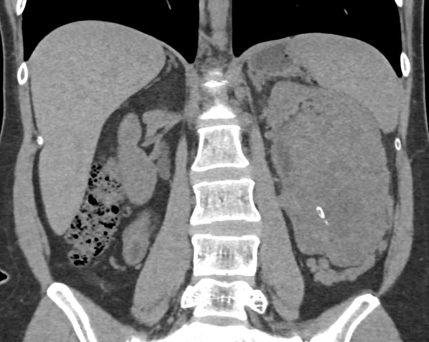 Renal Cell Carcinoma with Neovascularity - CTisus CT Scan