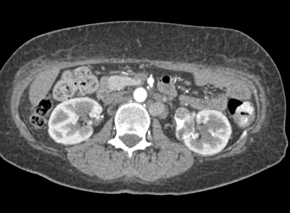 Renal Cell Carcinoma Left Kidney - CTisus CT Scan