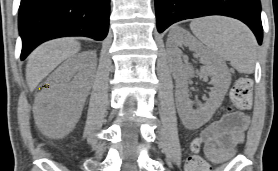 Small Angiomyolipoma (AML) of the Right Kidney - CTisus CT Scan