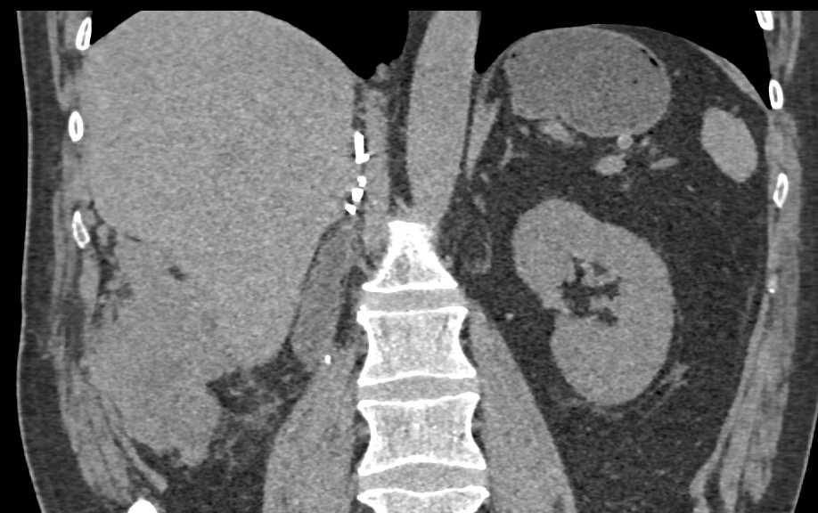 Recurrent Renal Cell Carcinoma - CTisus CT Scan