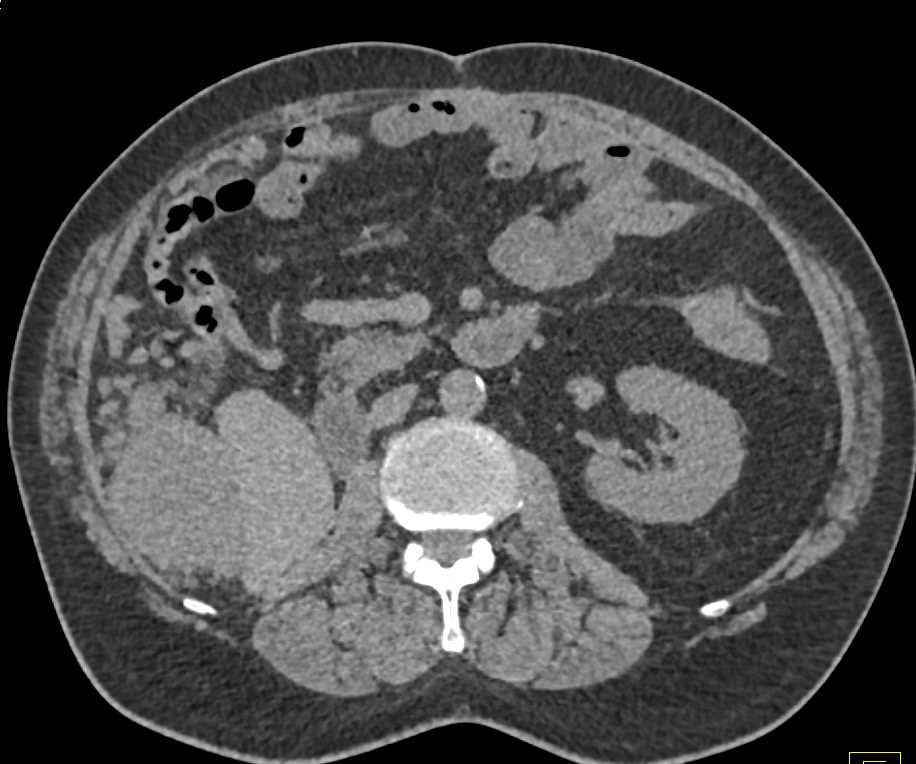 Recurrent Renal Cell Carcinoma with Vascular Metastases - CTisus CT Scan