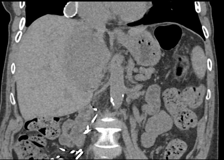 Recurrent Renal Cell Carcinoma in Patient with Inferior Vena Cava (IVC) Bypass Grafts - CTisus CT Scan