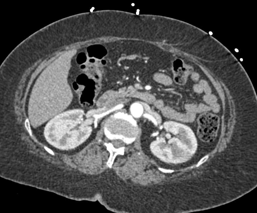 1cm Calcified Right Renal Artery Aneurysm - CTisus CT Scan