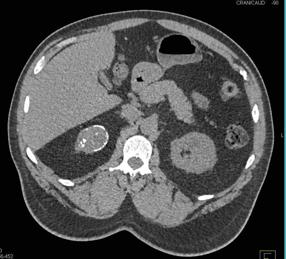 Partially Calcified Renal Cell Carcinoma - CTisus CT Scan