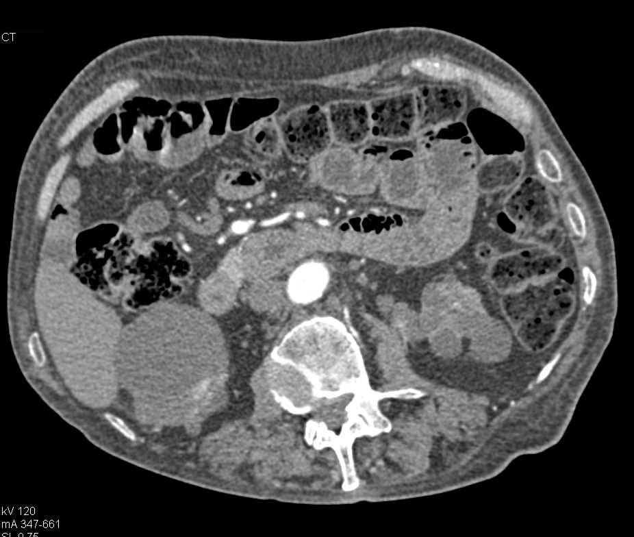 Cystic Renal Cell Carcinoma Lower Pole Right Kidney - CTisus CT Scan