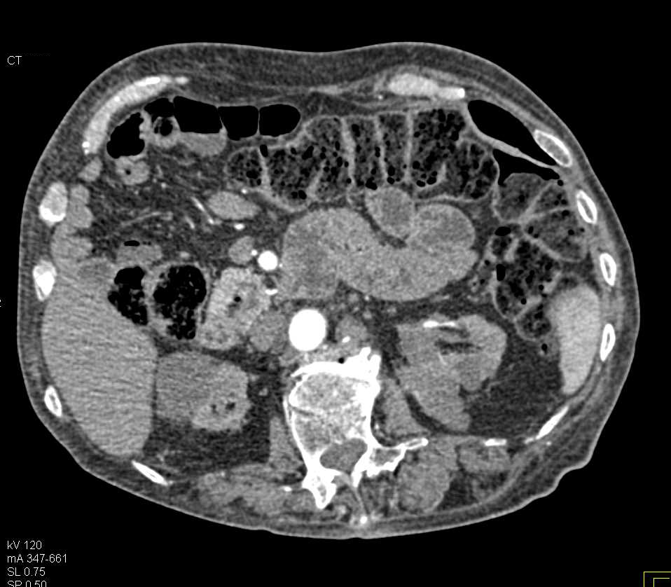 Cystic Renal Cell Carcinoma Lower Pole Right Kidney - CTisus CT Scan