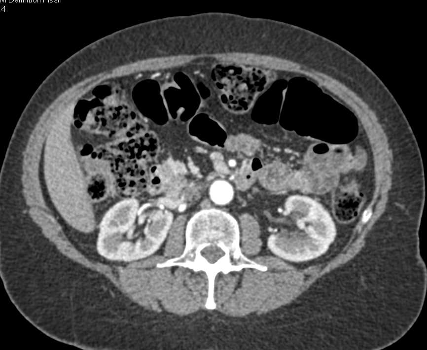 Recurrent Neuroendocrine Tumor in the Pancreatic  Bed - CTisus CT Scan