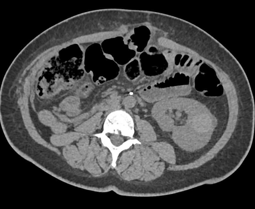 High Density Left Renal Cyst - CTisus CT Scan