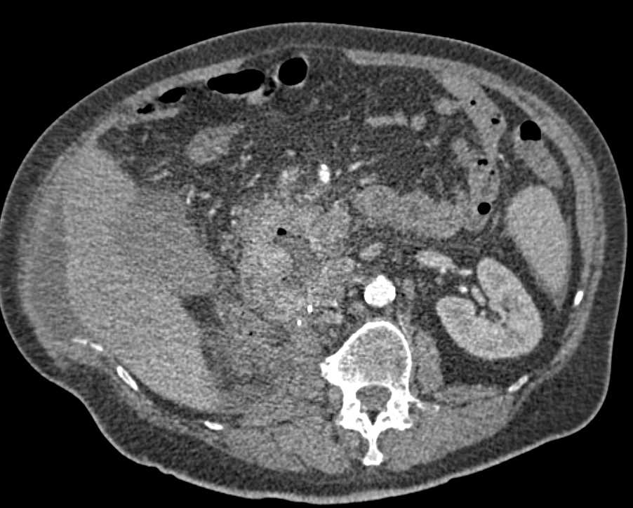 Recurrent Renal Cell Carcinoma with Metastases to the Duodenum - CTisus CT Scan