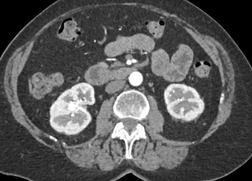 Arteriovenous (AV) Fistulae Right Kidney Best Seen on MIP Images - CTisus CT Scan