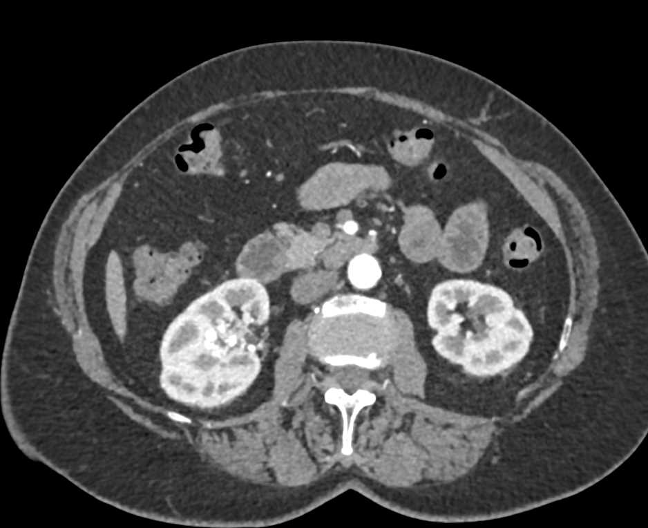 Arteriovenous (AV) Fistulae Right Kidney Best Seen on MIP Images - CTisus CT Scan