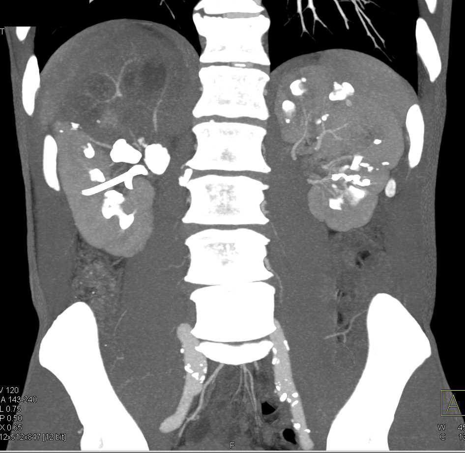 Focal Obstruction of the Upper Pole Calyces of the Right Kidney - CTisus CT Scan