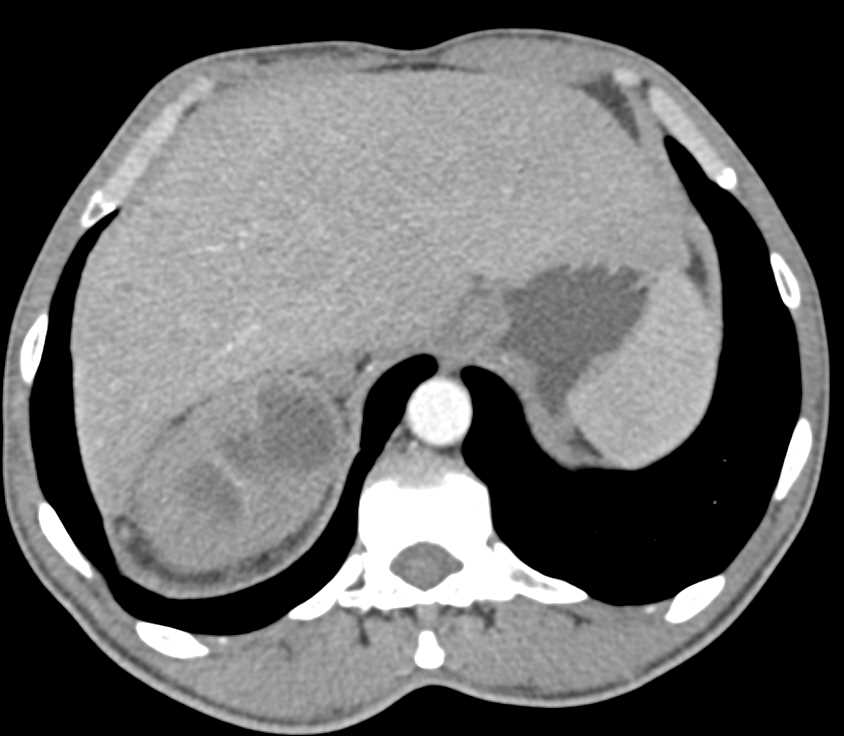 Focal Obstruction of the Upper Pole Calyces of the Right Kidney - CTisus CT Scan