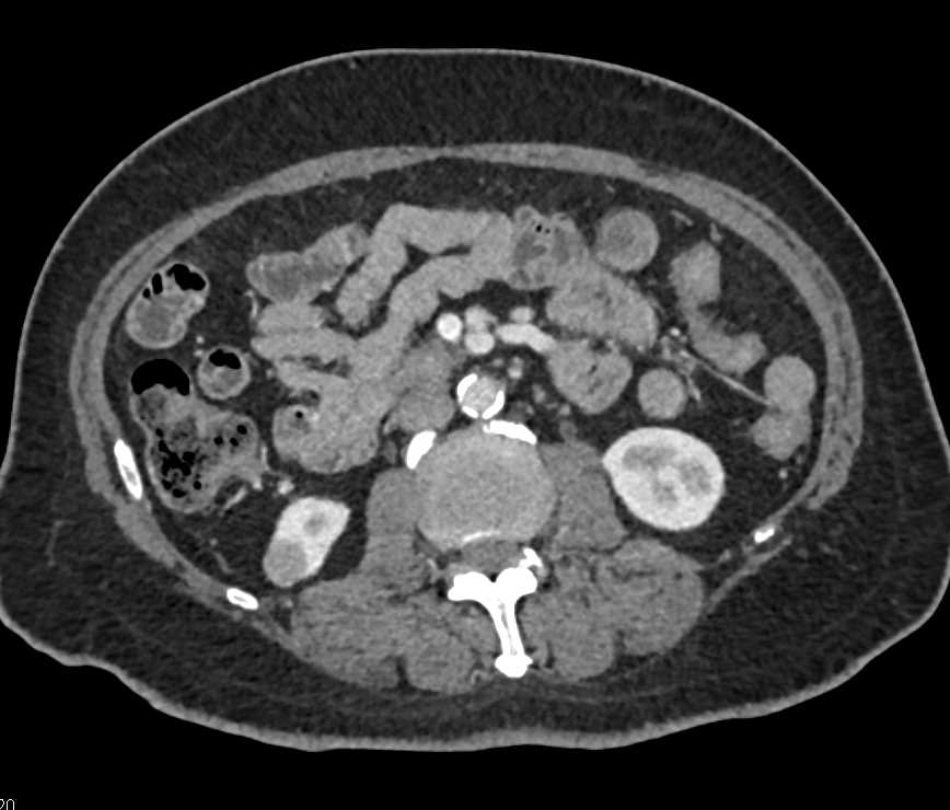 Complex Cyst Lower Pole Right Kidney - CTisus CT Scan