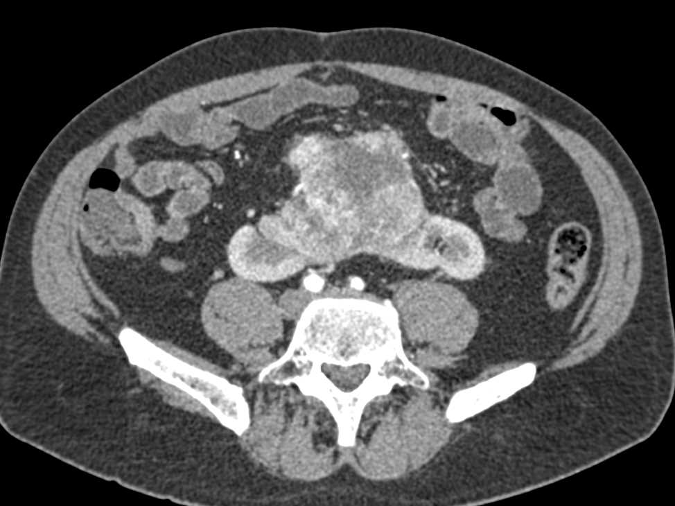 Renal Cell Carcinoma in a Horseshoe Kidney with CTA Mapping - CTisus CT Scan