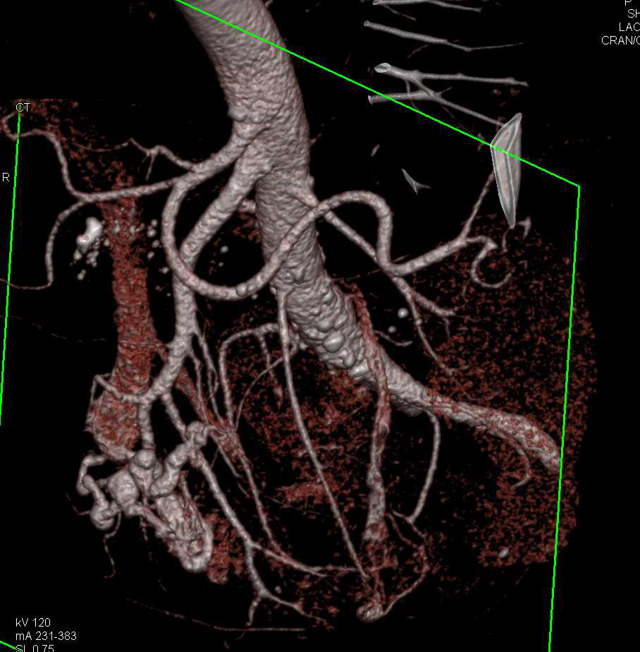 Renal Cell Carcinoma in a Horseshoe Kidney with CTA Mapping - CTisus CT Scan