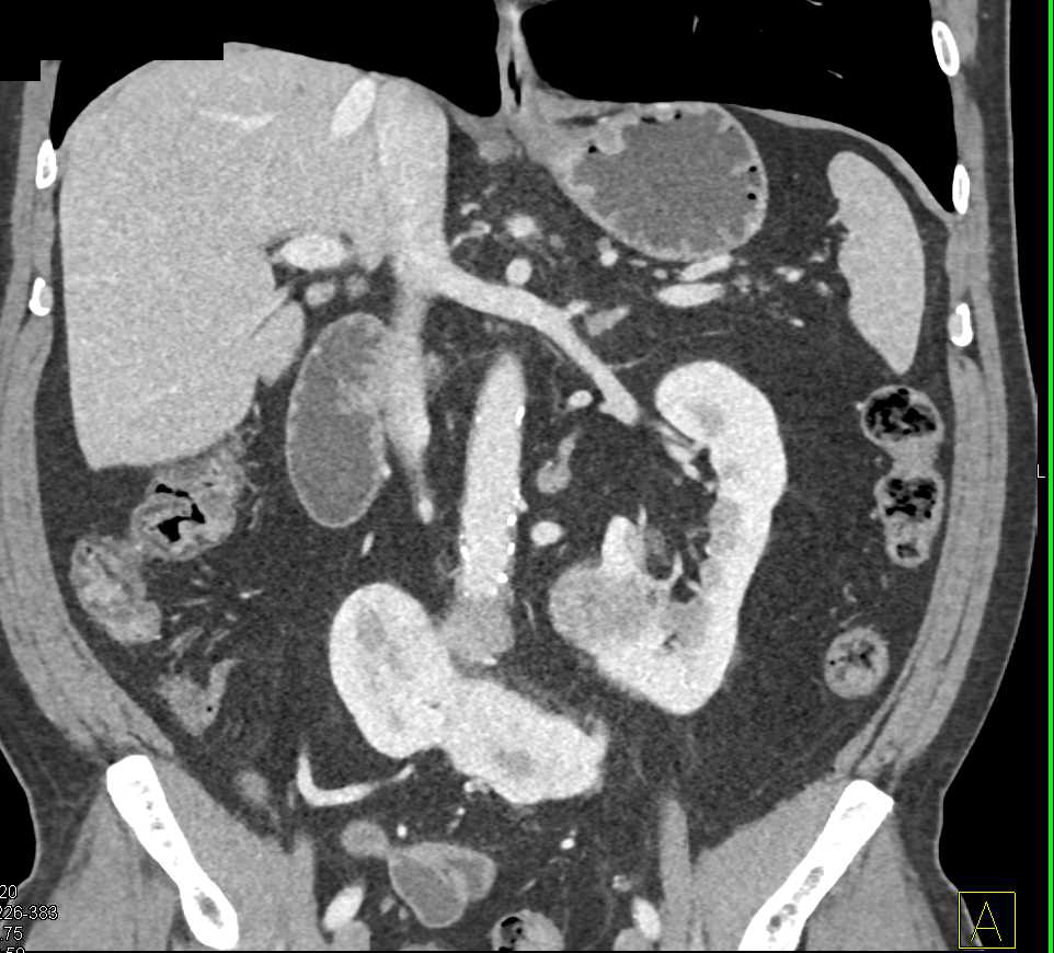 Renal Cell Carcinoma in a Horseshoe Kidney - CTisus CT Scan