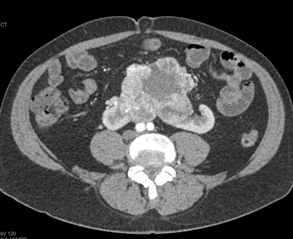 Renal Cell Carcinoma in a Horseshoe Kidney - CTisus CT Scan