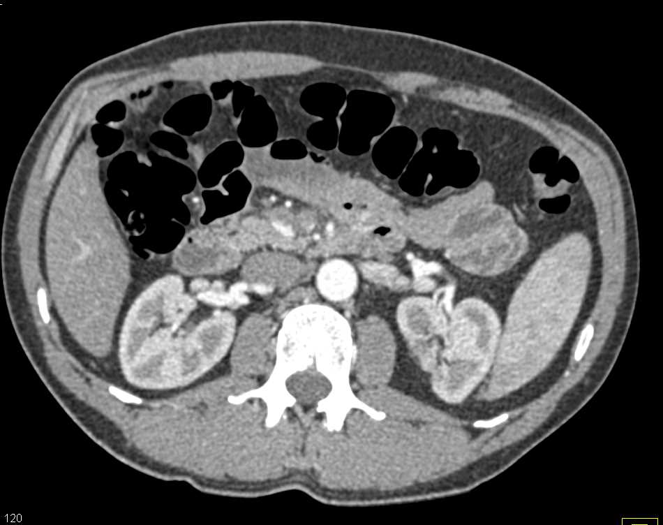 Infarction Lower Pole Right Kidney - CTisus CT Scan