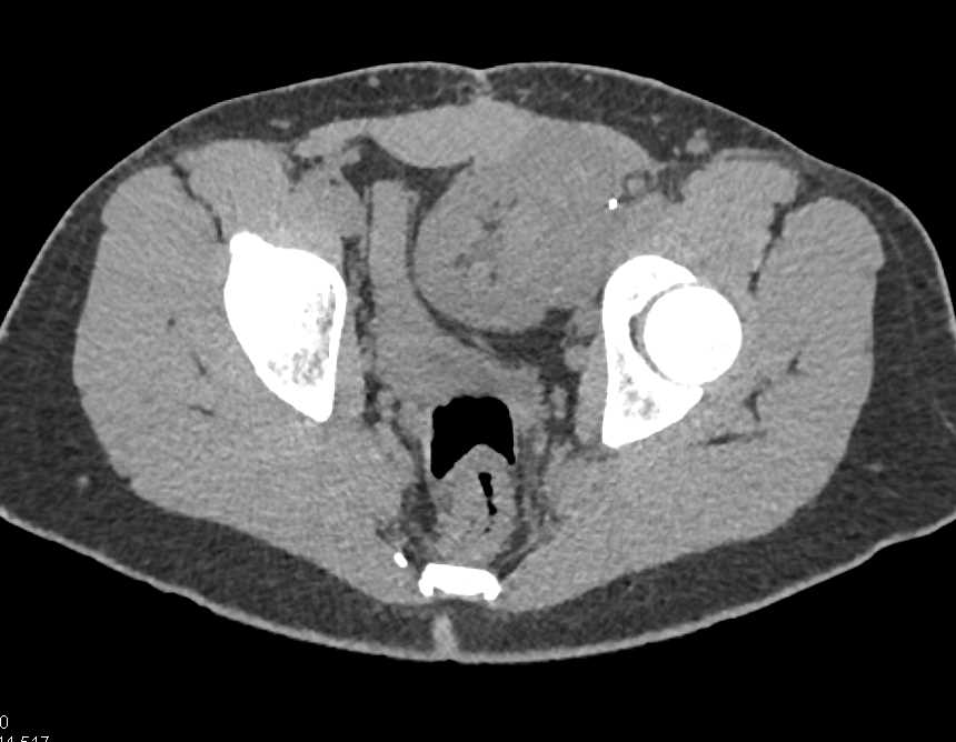 Renal Cell Carcinoma in a Transplant Kidney - CTisus CT Scan