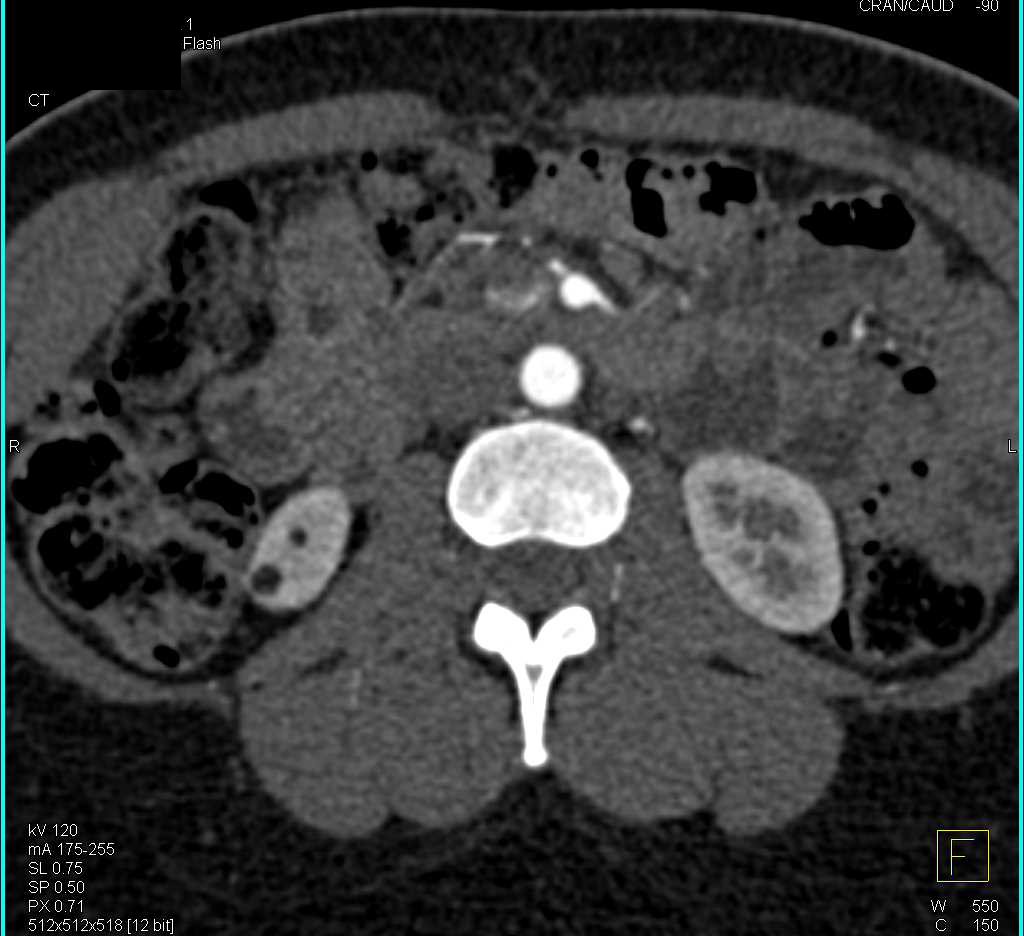 Incidental Angiomyolipoma (AML) Right Kidney - CTisus CT Scan