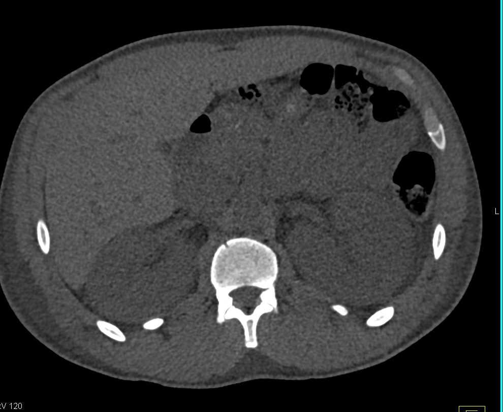 Acute Pyelonephritis Left Kidney - CTisus CT Scan