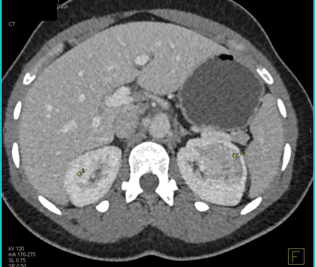 Oncocytoma Left Kidney - CTisus CT Scan