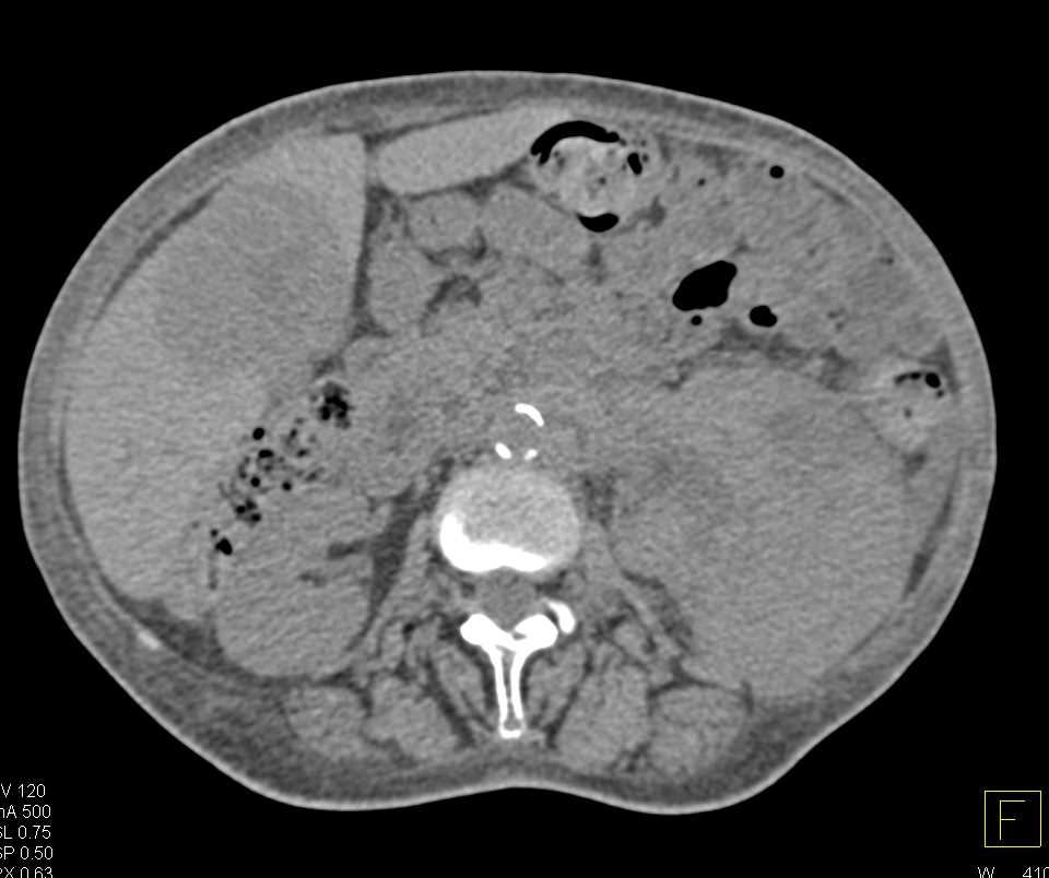 Renal Cell Carcinoma with Liver Metastases - CTisus CT Scan
