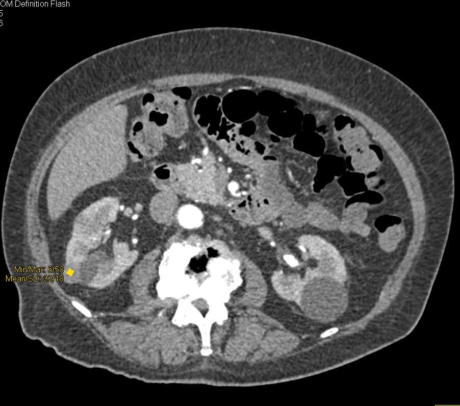 Multiple High Density Cysts in the Kidney - CTisus CT Scan