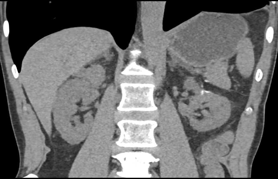 Transitional Cell Carcinoma Right Kidney - CTisus CT Scan